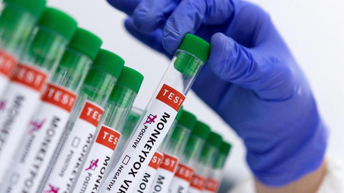 Suspected Mpox Case Reported In Kerala’s Malappuram; State On High Alert